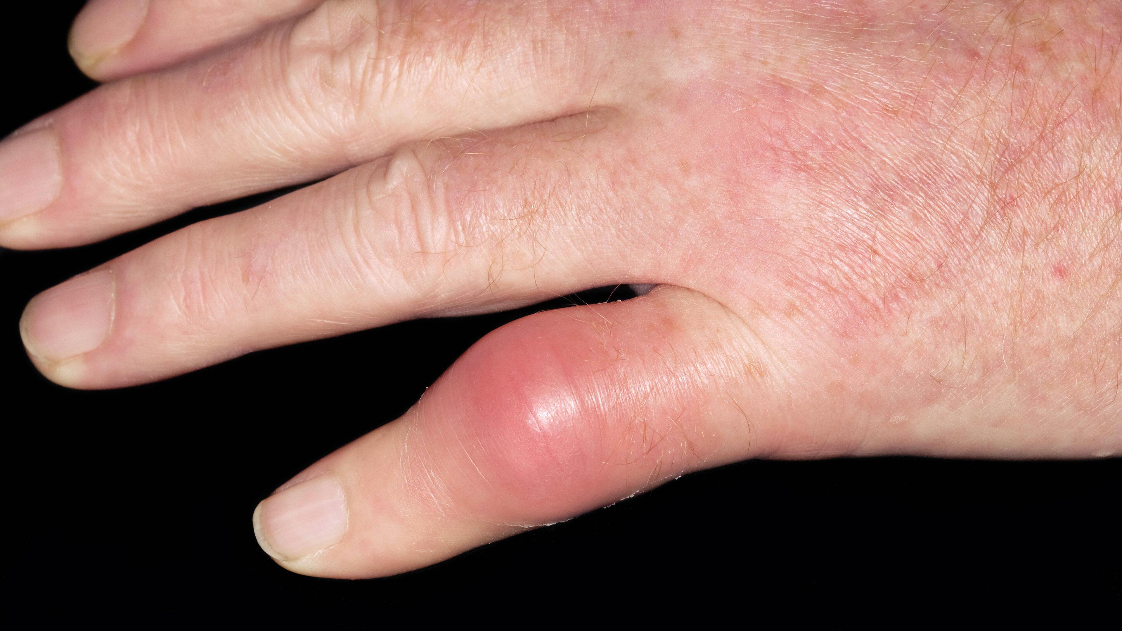 Die Hand eines Mannes mit Gicht, aufgenommen am 27.08.2014
